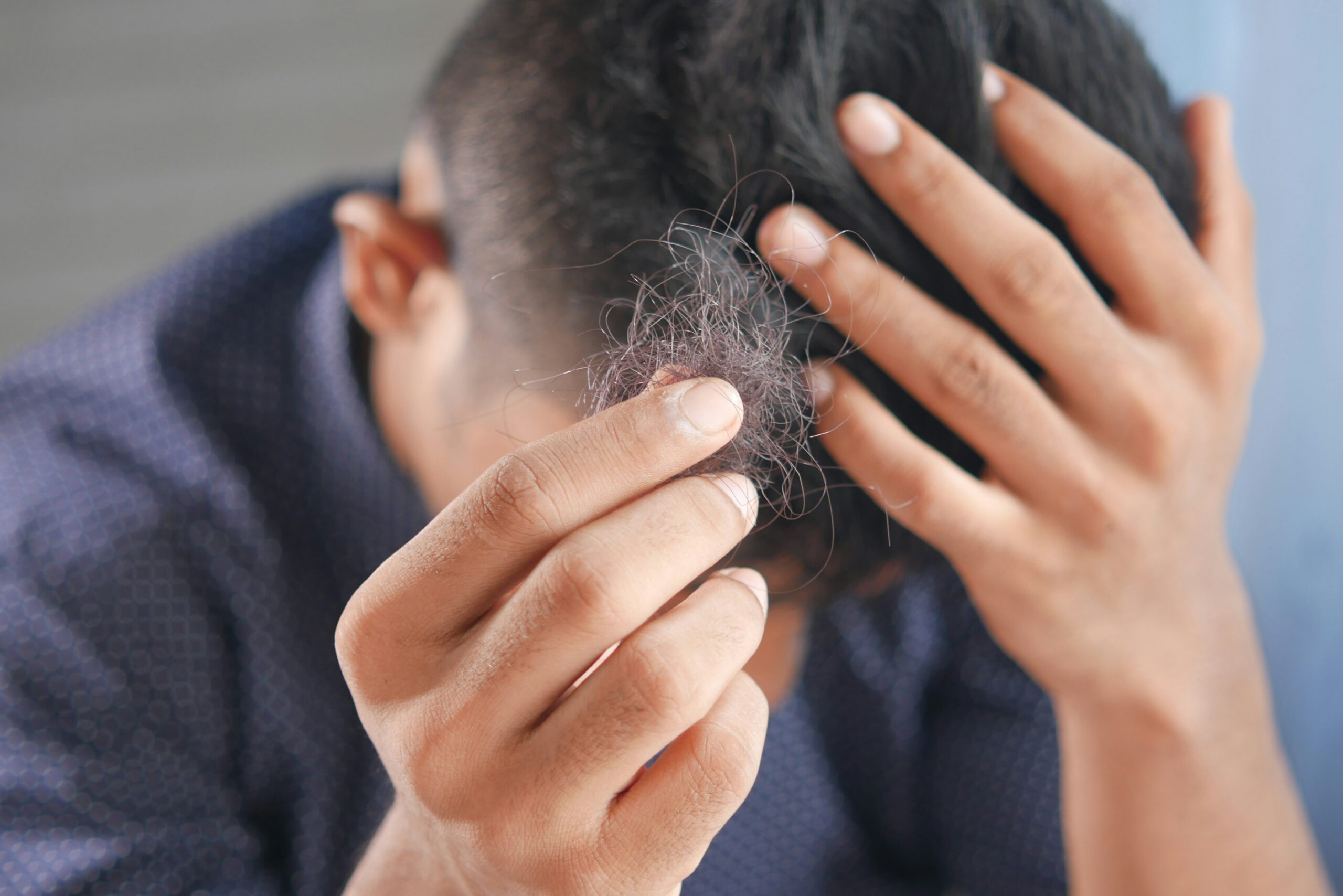 Perte de cheveux chez homme